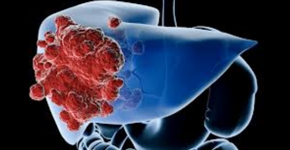 Una terapia con un fármaco contra el VIH puede frenar el cáncer de hígado