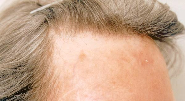 alopecia.jpg